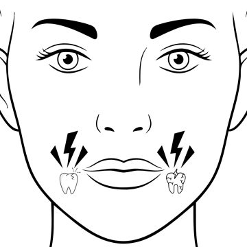 Botox im Masseter zur Behandlung von Zähneknirschen Behandlung der Masseter-Muskulatur bei Zähneknirschen mit Botox